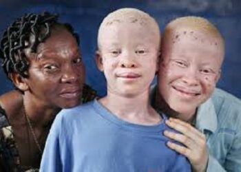 Les albinos demandent à l’Etat de régler les problèmes liés à leur handicap