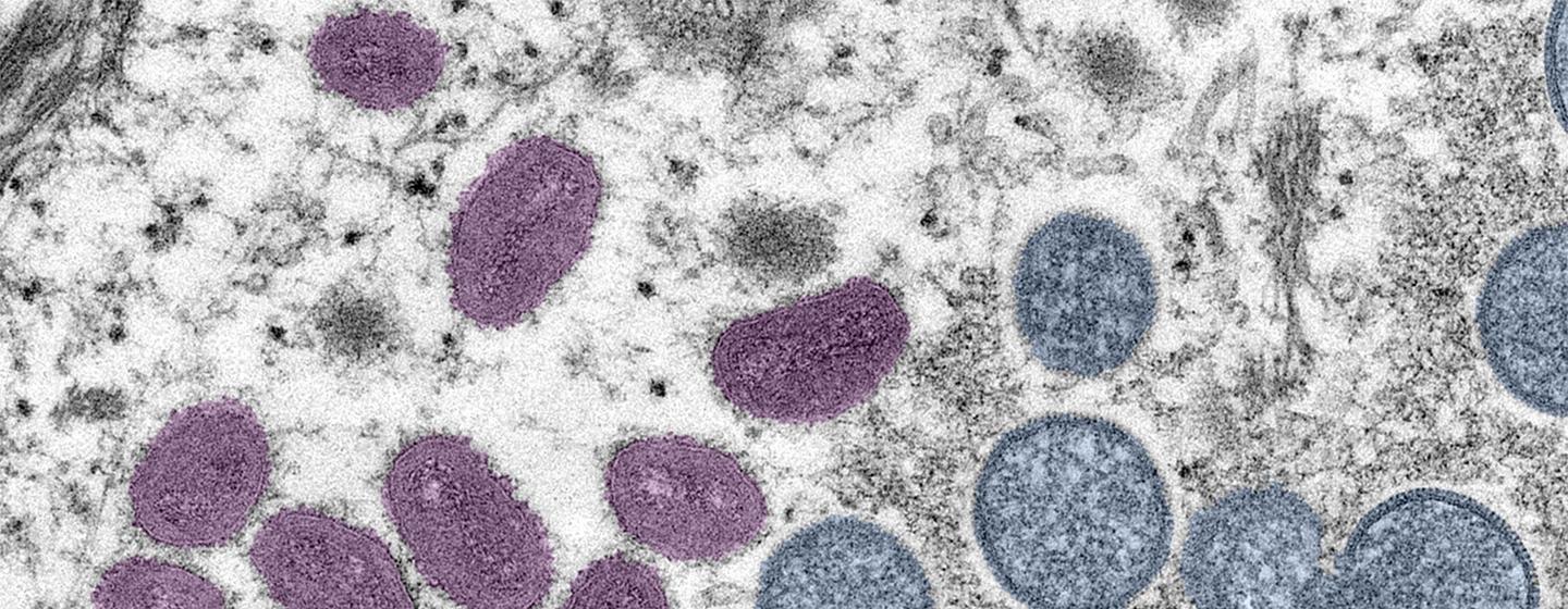 La variole du singe qu’est-ce que c’est, comment elle se propage, qui est à risque et comment se protéger