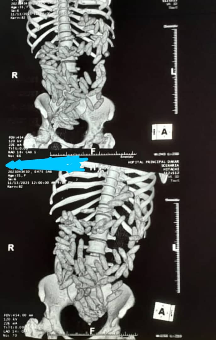 Une ressortissante sud-africaine arrêtée par la Cellule aéroportuaire anti-Trafics (CAAT) de l’AIBD avec des boulettes de cocaïne dans l’estomac.