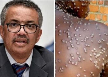 RÉSURGENCE DE LA VARIOLE DE SINGE(MPOX) EN AFRIQUE