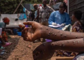 ALERTE SANTÉ- UN DEUXIÈME CAS MPOX CONFIRMÉ  À DAKAR SELON LES AUTORITÉS SANITAIRES