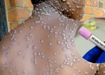 Épidémies au Sénégal :Mpox et la Fièvre de la Vallée du Rift à Saint-Louis